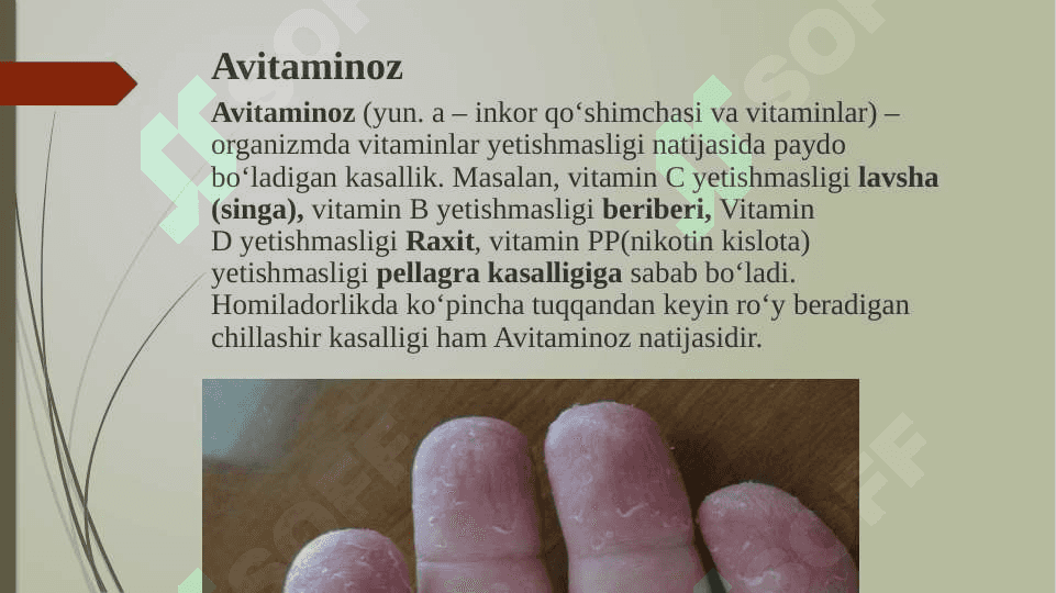 Avitaminoz. Gipovitaminoz. 2
