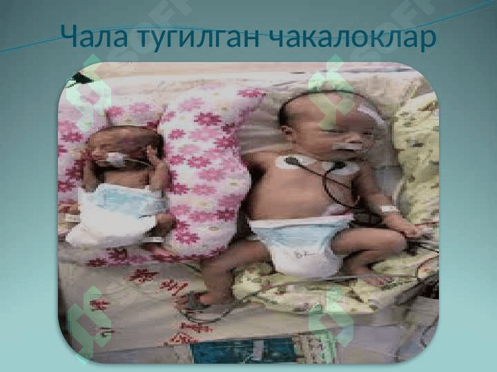 Chala tug`ilgan chaqaloqlar . Чала тугилган чакалоклар 5