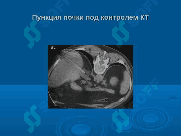 Эндоскопическая урология. 4