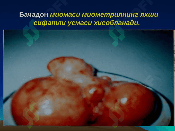 BACHADON MIOMASI 2