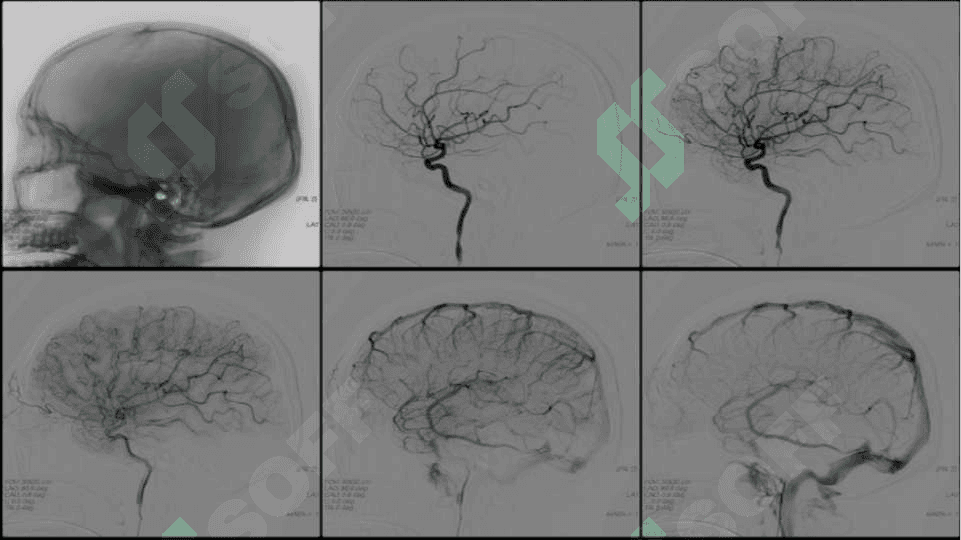 ​ANGIOGRAFIYA​​ ​​ 3