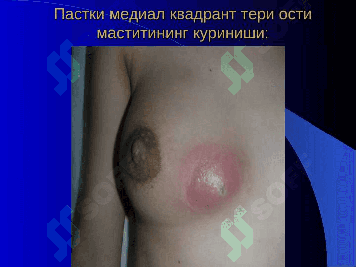«Мастит, панариций ва кафт флегмоналари. MASTIT FLEGMONA 7