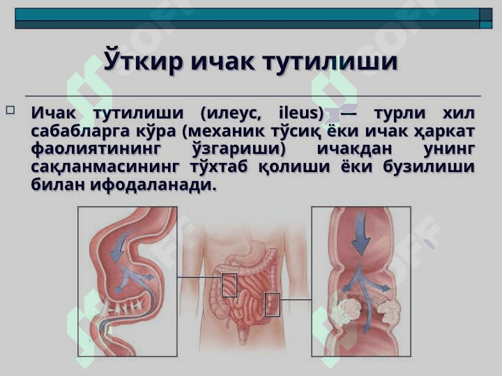 O`TKIR ICHAK TUTILISHI 2