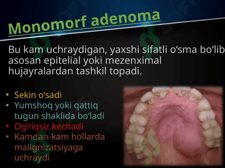 So’lаk bеzlаri o’smаlаri. Mоnоmоrf аdеnоmа, pоlimоrf аdеnоmа, mukоepidеrmоid o’smа. Klinikаsi, tаshxislаsh vа dаvоlаsh. Аdеnоkаrsinоmа. Tаshxislаsh vа dаvоlаsh prinsiplаri. 3