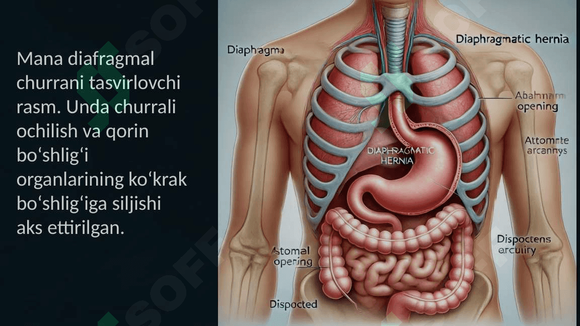 Diafragmal churralar xirurgiyasi 7