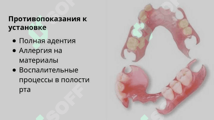 Изготовление бюгельных протезов из современных материалов ( Валлпласт , Квадротти ) . Их положительные и отрицательные качества . Клинико лабораторные этапы 7