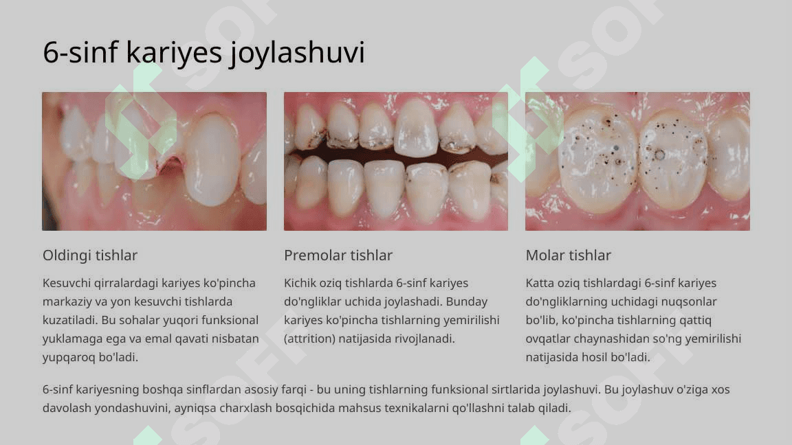 6-sinf karies kovaklarni charxlashning o‘ziga xos tomonlari. 4