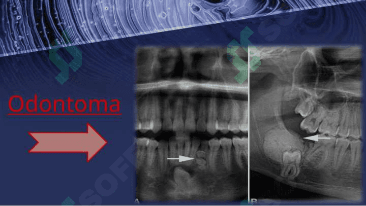 Odontogen o'smalar. Klinikasi, tashxisi, davolash 6