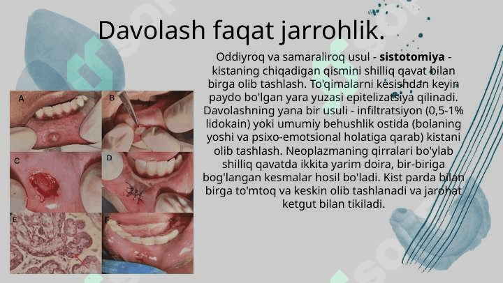 Bolalarda so’lak bezlarining xavfsiz va xavfli o’smalari. 6