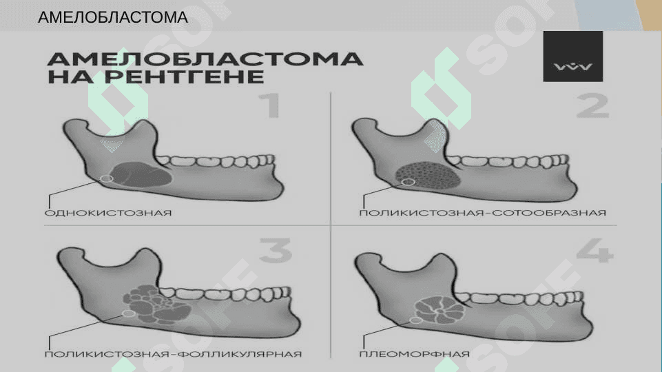 Odontogen o’smalar.Ameloblastoma klinikasi tashxislash, davolash.Odontoma ,sementoma odontogen fibroma.Klinika,tashxis,davolash. 4