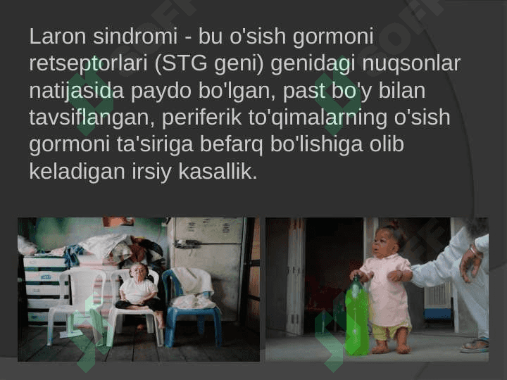 Laron Sindromi 2