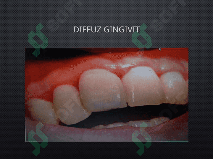 Gum va periodontal kasalliklar 5