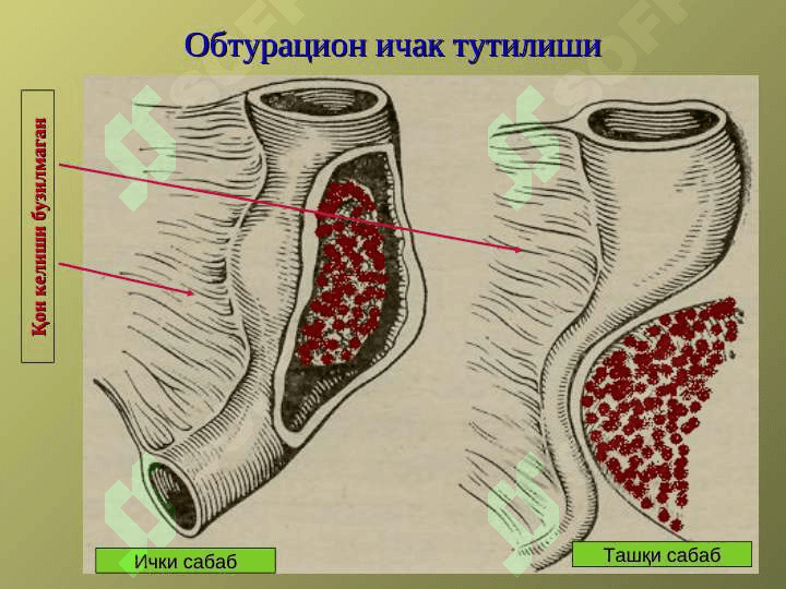 Уткир ичак тутилиши 4