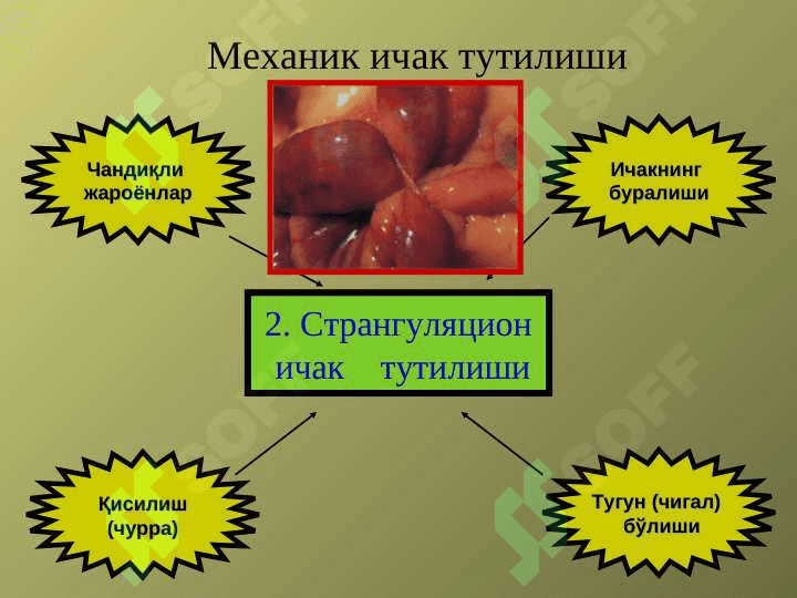 Уткир ичак тутилиши 5