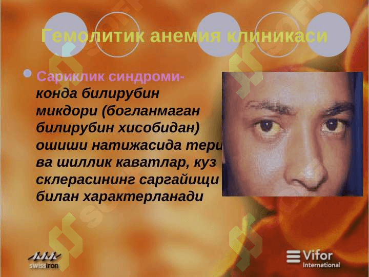 Гемолитик  анемия 4