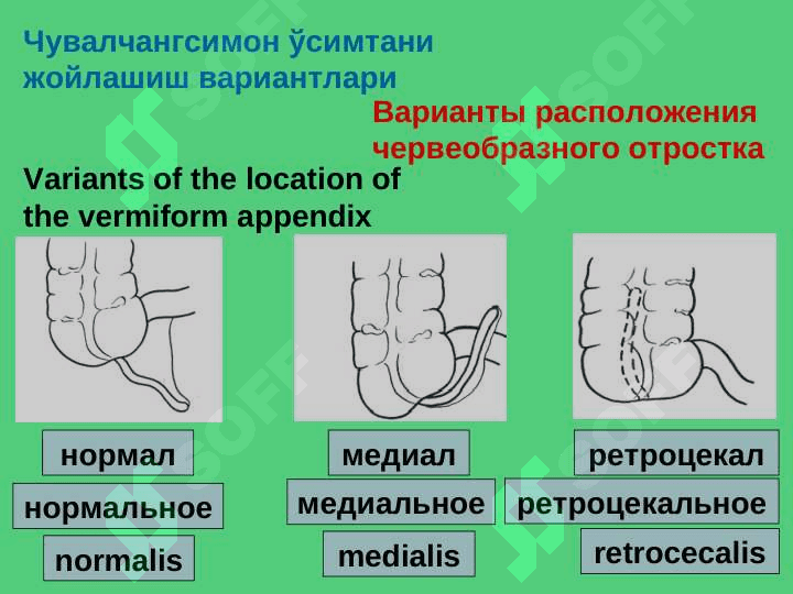 Острый аппендицит 3