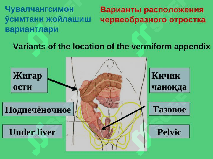 Острый аппендицит 4