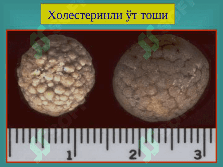 Ўт тош ва тошсиз холецистит 8