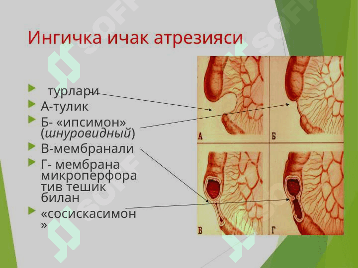 Ичак тутилиши 8