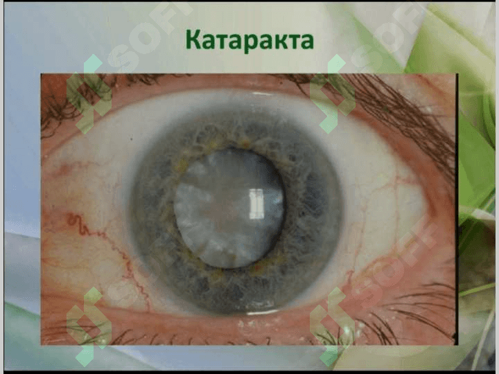 Катаракта 2