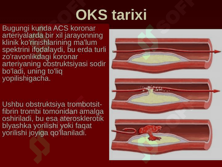 O'tkir koronar sindrom 8