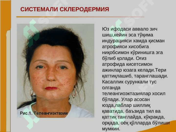 Bo`g`im va biriktiruvchi to`qima kasalliklari bilan og`rigan bemorlarni tekshirish. SKV, SSD, RA, DOA kasalliklarini asosiy klinik simptomlari. Avtoimmun kasalliklar. Revmatoid artrit. Sklerodermiya. Osteosrtroz. 5