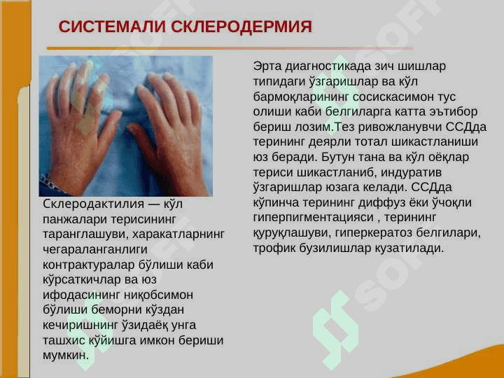 Bo`g`im va biriktiruvchi to`qima kasalliklari bilan og`rigan bemorlarni tekshirish. SKV, SSD, RA, DOA kasalliklarini asosiy klinik simptomlari. Avtoimmun kasalliklar. Revmatoid artrit. Sklerodermiya. Osteosrtroz. 6