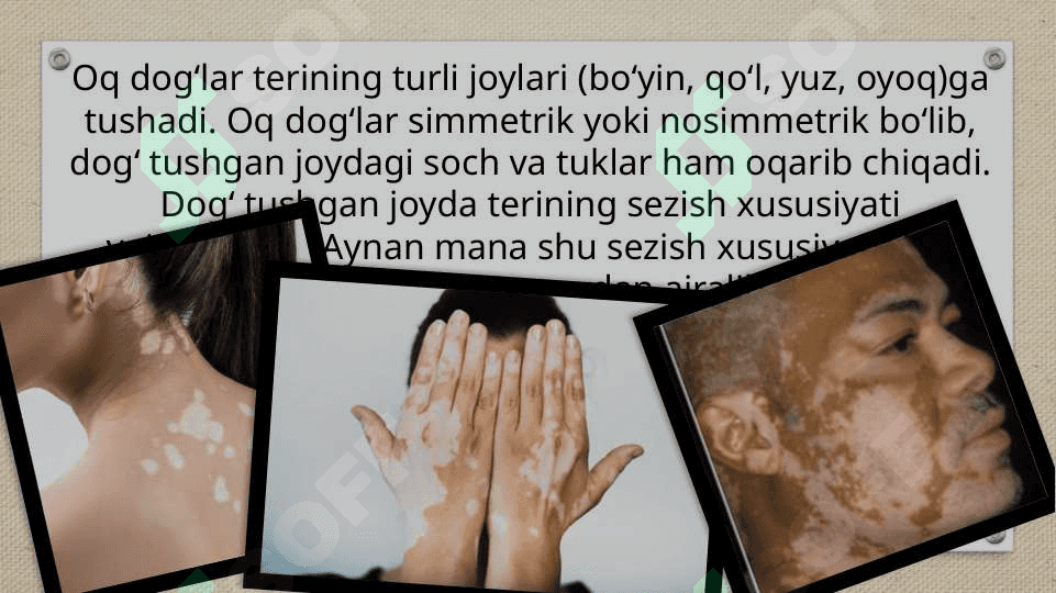 Vitiligoning zamonaviy davolash usullari 4