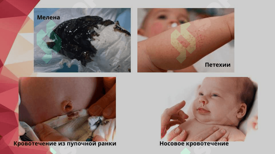 Геморрагическая болезнь новорожденных 7