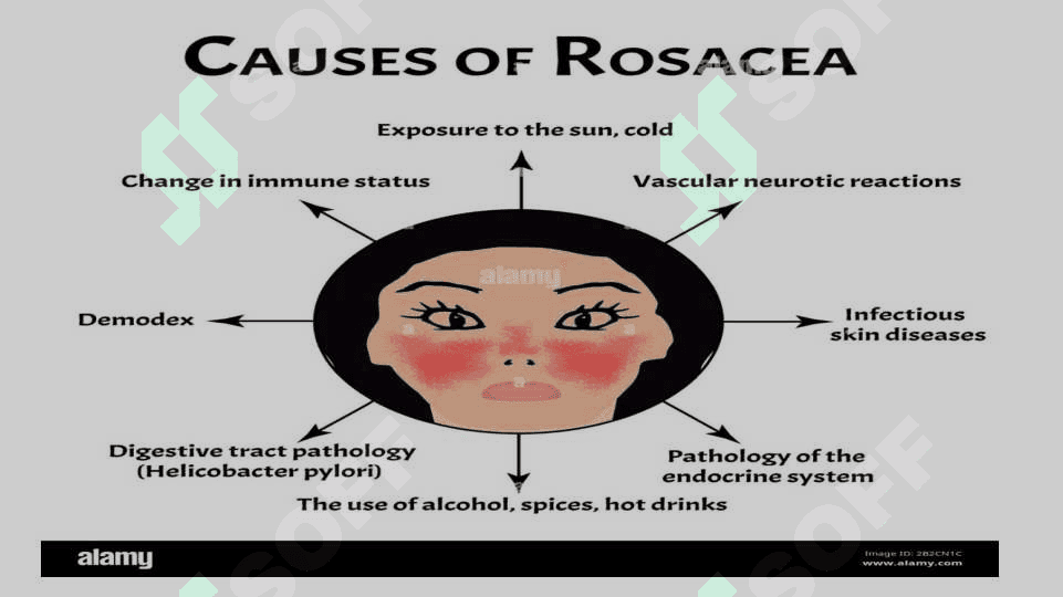 Pushti rangli husnbuzar (Acne rosacea) 3