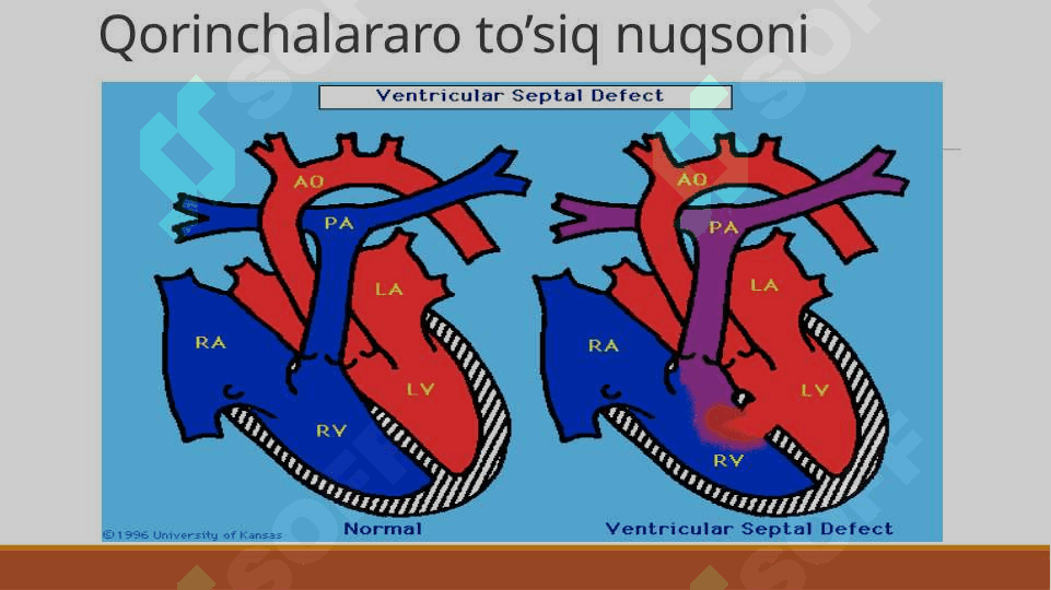 Yurak poroklari (nuqsonlari). Porok turlari, ularda qon aylanishning asosiy ko’rinishlari - Юрак пороклари (нуқсонлари). Порок турлари, уларда қон айланишнинг асосий кўринишлари 6