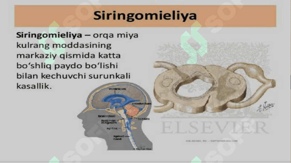 Siringomiyeliya 3