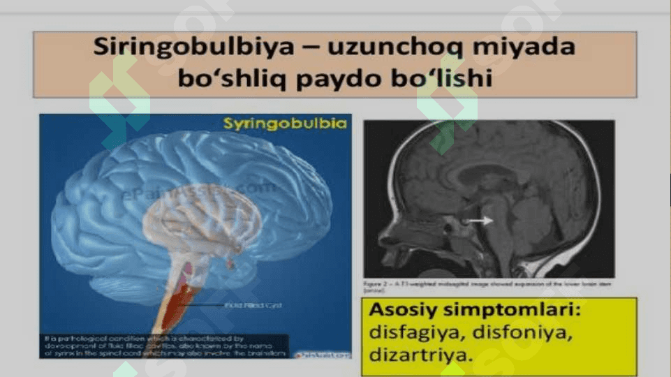 Siringomiyeliya 4