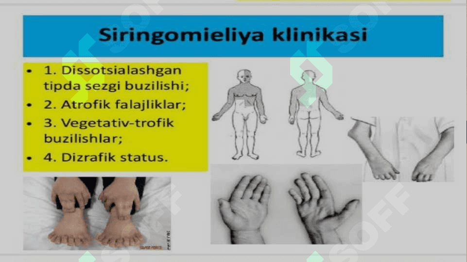 Siringomiyeliya 8