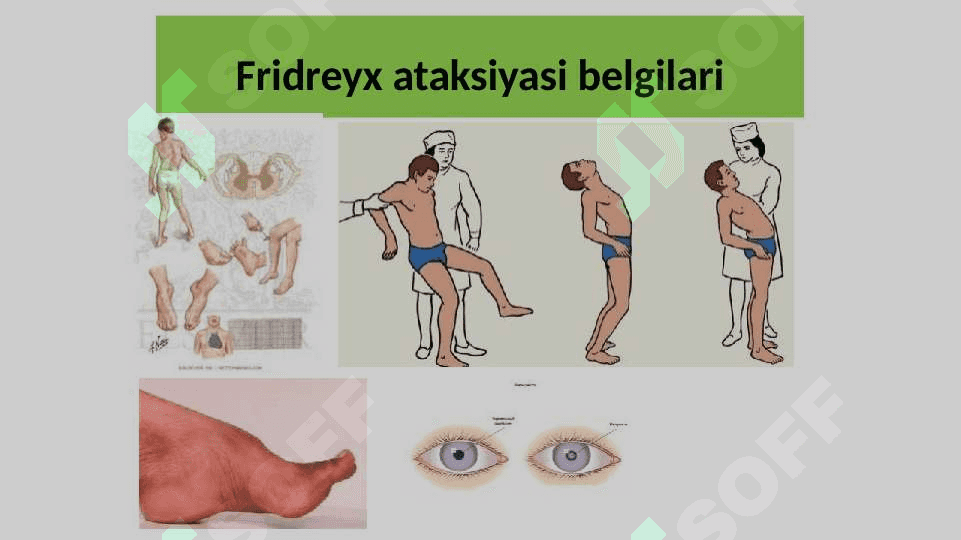 Nasliy asab kasalliklari 8