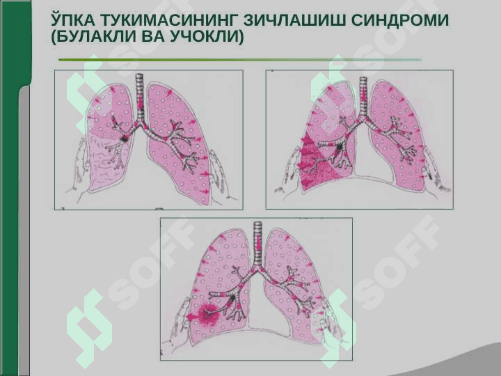 NAFAS OLISH ORGANI KASALLIKLARINING ASOSIY KLINIK SINDROMLARI. O`PKA TO`QIMASINING ZICHLASHISH SINDROMI. PLEVRA BO`SHLIG`IGA HAVO VA SUYUQLIK TO`PLANISH SINDROMI, O`PKADA BO`SHLIQ HOSIL BO`LISH SINDROMI. 3