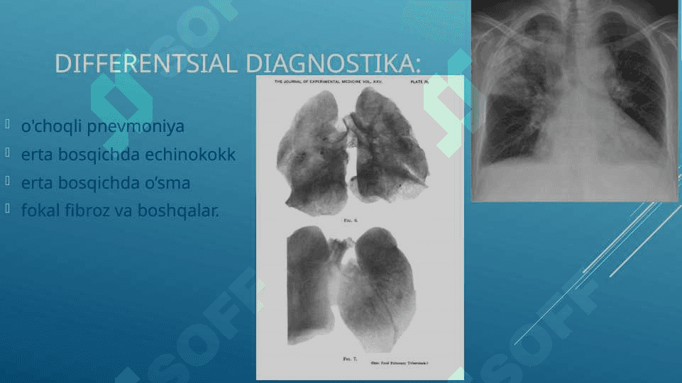 o’choqli tuberkulyoz tuberkulyoma 8