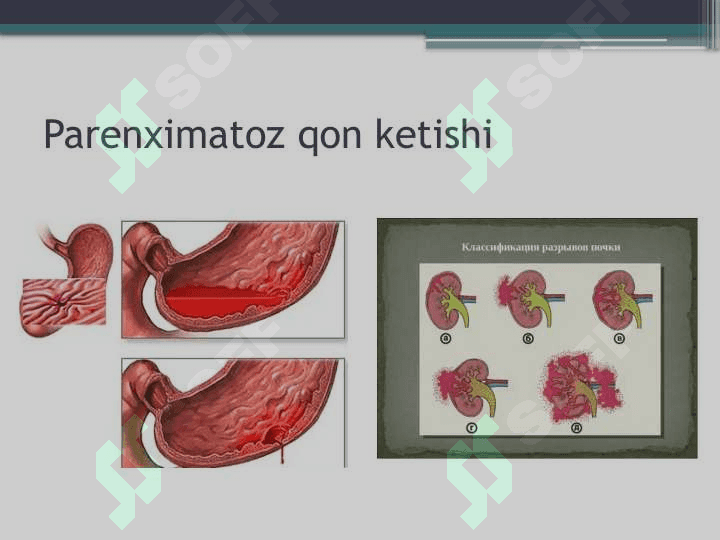 Qon ketishi va qon yo'qotish 7