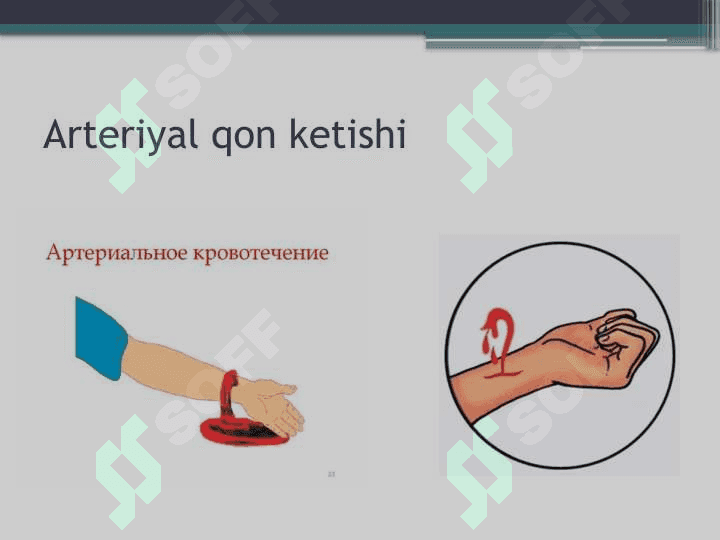 :Qon ketishini vaqtincha va batamom to'xtatish 4