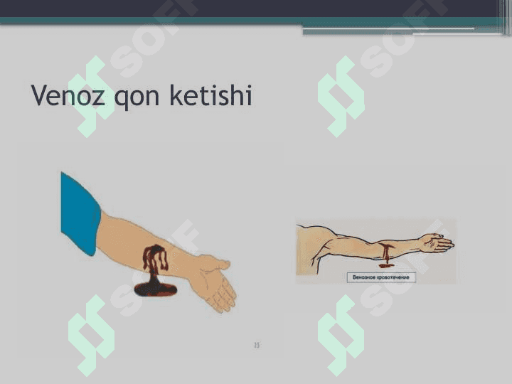 :Qon ketishini vaqtincha va batamom to'xtatish 5