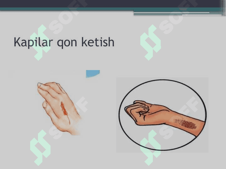 :Qon ketishini vaqtincha va batamom to'xtatish 6
