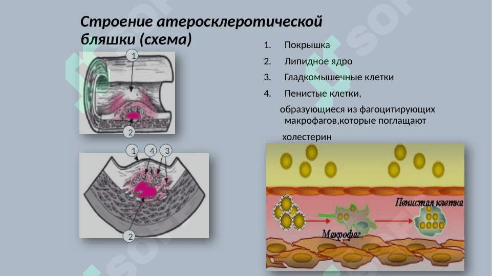 Атеросклероз 8