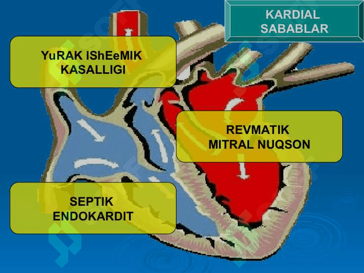 O‘tkir arterial tromboz va emboliyalar 4