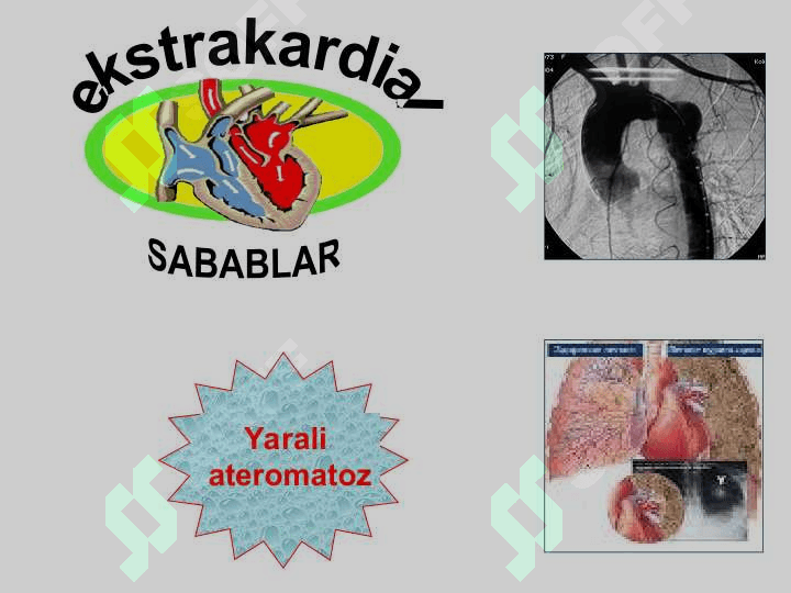 O‘tkir arterial tromboz va emboliyalar 7