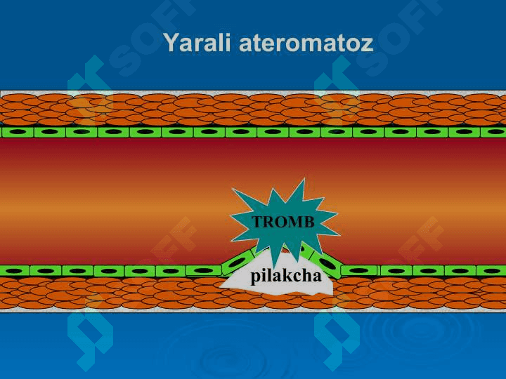 O‘tkir arterial tromboz va emboliyalar 8