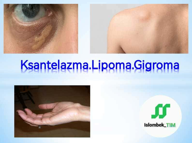 Ksantelazma. Lipoma. Gigroma