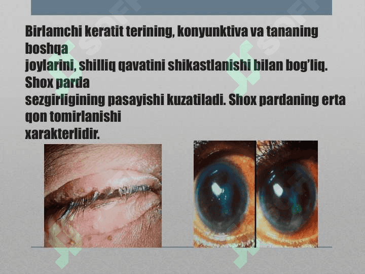 Gerpetik Keratit 3