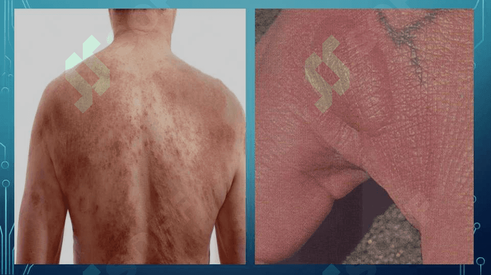 Dermatit - Дерматит 6