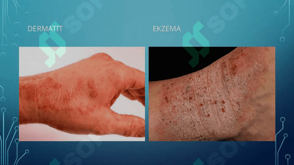 Dermatit - Дерматит 8