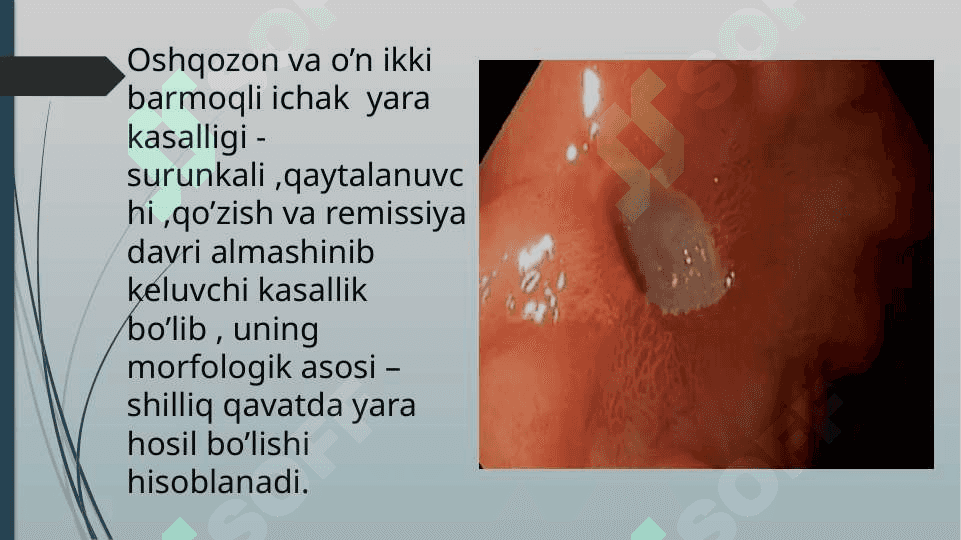 oshqozon yara kasalligi 3